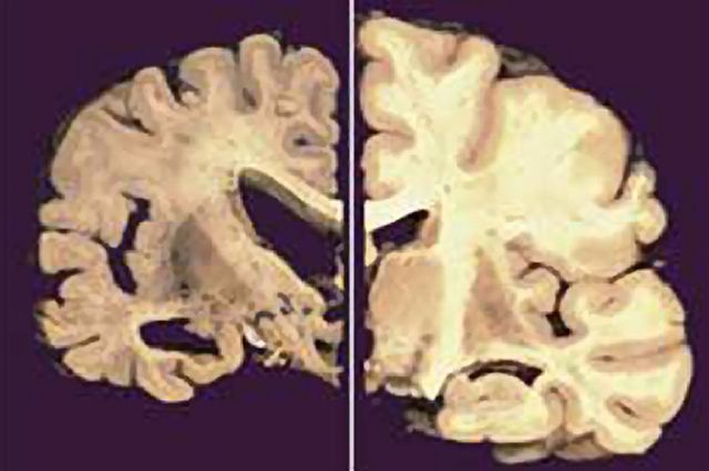 Mit Alzheimer kommt es zu einem fortschreitenden Abbau im Gehirn. Im Bild: Hirnschnitte mit Alzheimer (links) und ohne (rechts).
